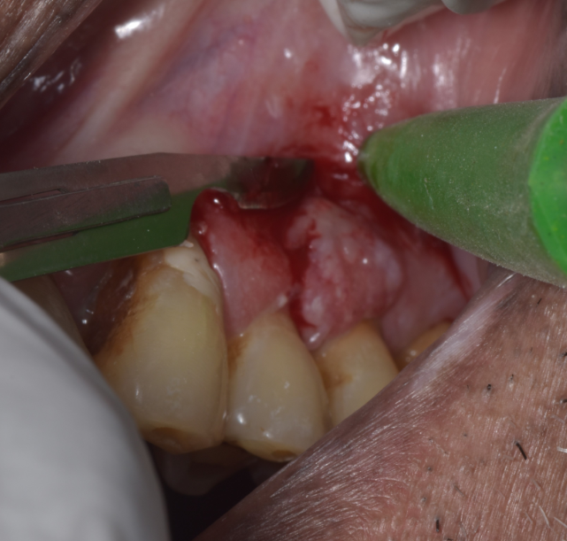 Excision of gingival lesion