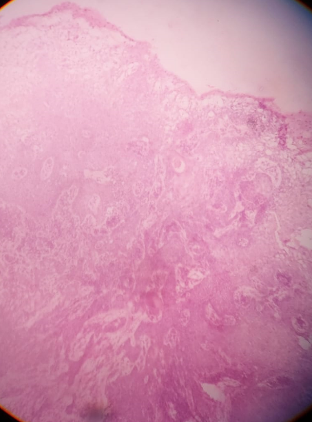 Histopathology showing keratin pearls