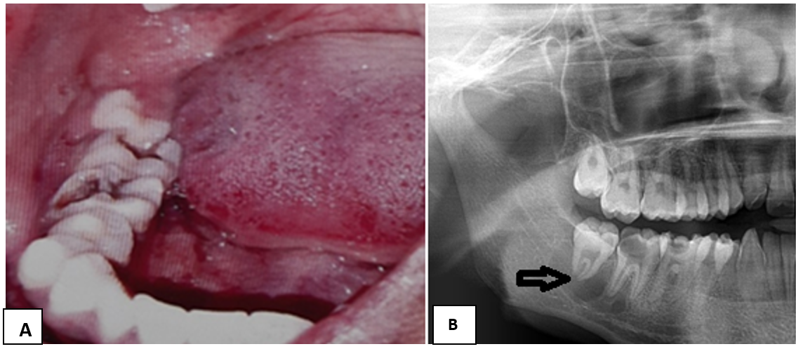 A): Showing 46, 47 decayed and pericoronitis in relation to 48. B): Radiograph with arrow showing periradicular hypodensity around 47, 48 root