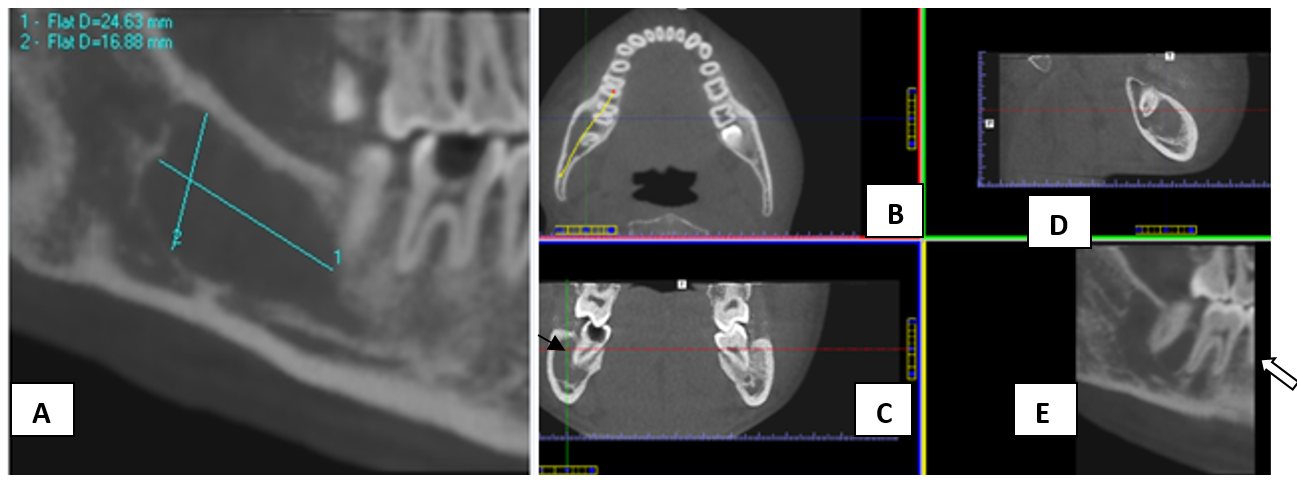 A,B,C,D,E): CBCT scan showing a well defined hypodense lesion in mandibular body (47 and 48 region). Black arrowhead in 2C showing thin buccal wall of decayed 47. White arrowhead in 2E showing scalloped border interdentally
