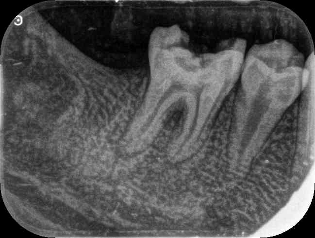 Radiographic evaluation of operative site after 04 months shows decrease in hypodensity with trabecular bone