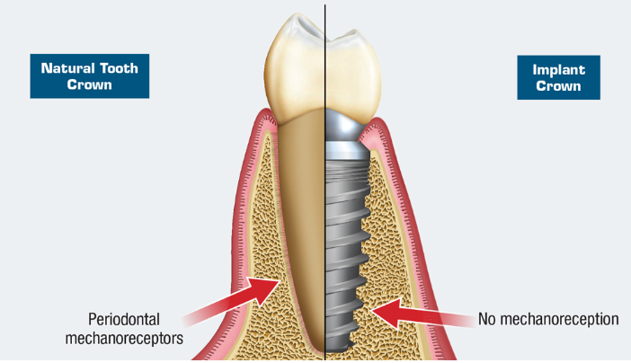 The natural tooth contains a periodontal ligament, whereas an implant lacks a PDL and has a direct bone interface