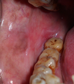Intra oral examination showed reticular network of slightly-raised,gray-white line seen on right side buccal mucosa.