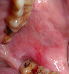 Left sidebuccal mucosa showing reticular network of slightly-raised, gray-white line.