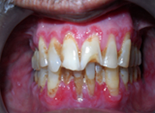 Intraoral examination showed desquamation of gingiva.