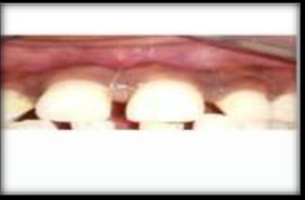 Pigmented gingival tissue