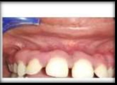 Depigmentation post 2 week follow up.