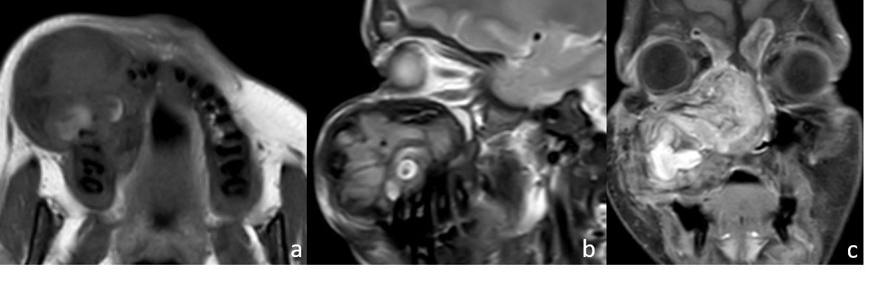 T1 axial (a): T2 sagittal (b): and coronal post contrast T (c): MRI sequences of a 20-year-old male with known history of chronic renal failure with renal osteodystrophy and on dialysis past 6 years, presented with painful right cheek swelling for 6 months, shows an expansile right maxillary lesion protruding into nasal cavity It appears hypointense on T1W; (a): with few hyperintense areas and intermediate on T2W; (b): and shows heterogenous post contrast enhancement; (c): PTH levels were elevated (619 pg/ml) and histopathological analysis supported the diagnosis of Browns tumor.