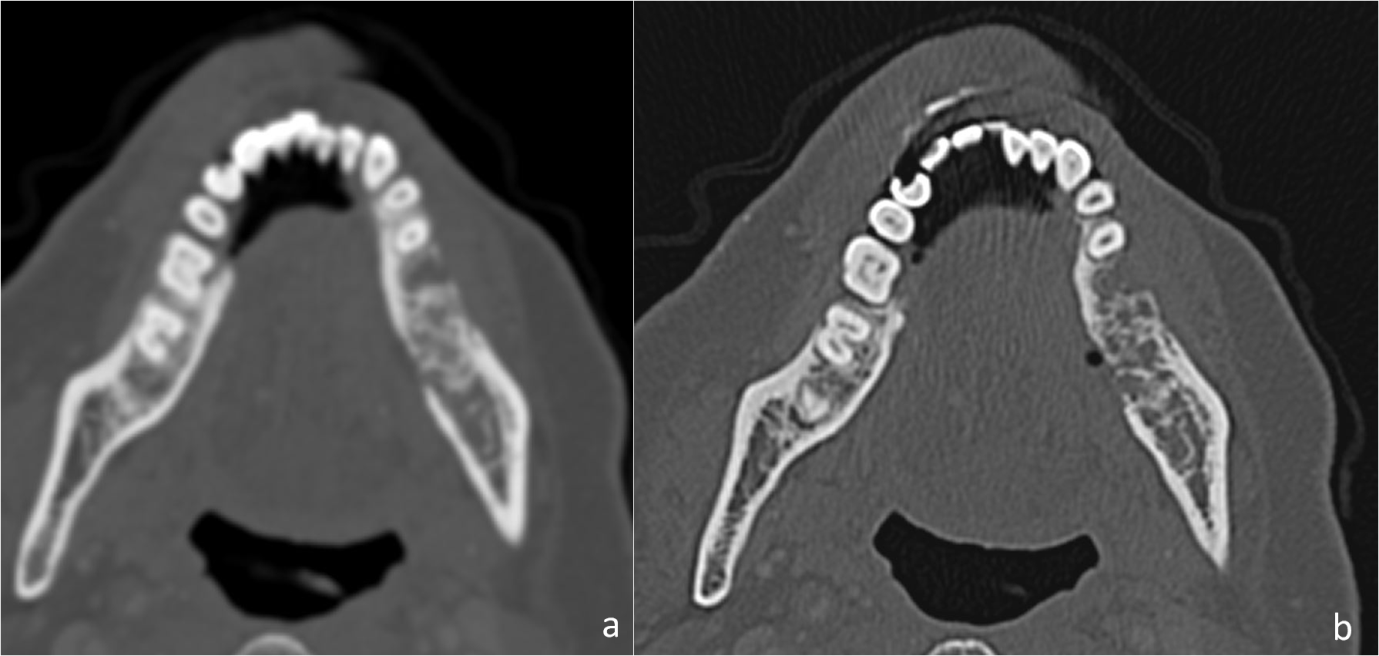 Axial soft tissue.(a): and bone window; (b): CT images of a 48-year-old woman with history of left buccal mucosal carcinoma, post-radiation therapy status, shows left mandibular lesion with permeative lytic destruction of mandibular alveolus with increased trabecular markings and cortical erosion. The clinico-radiological features suggested osteoradionecrosis.