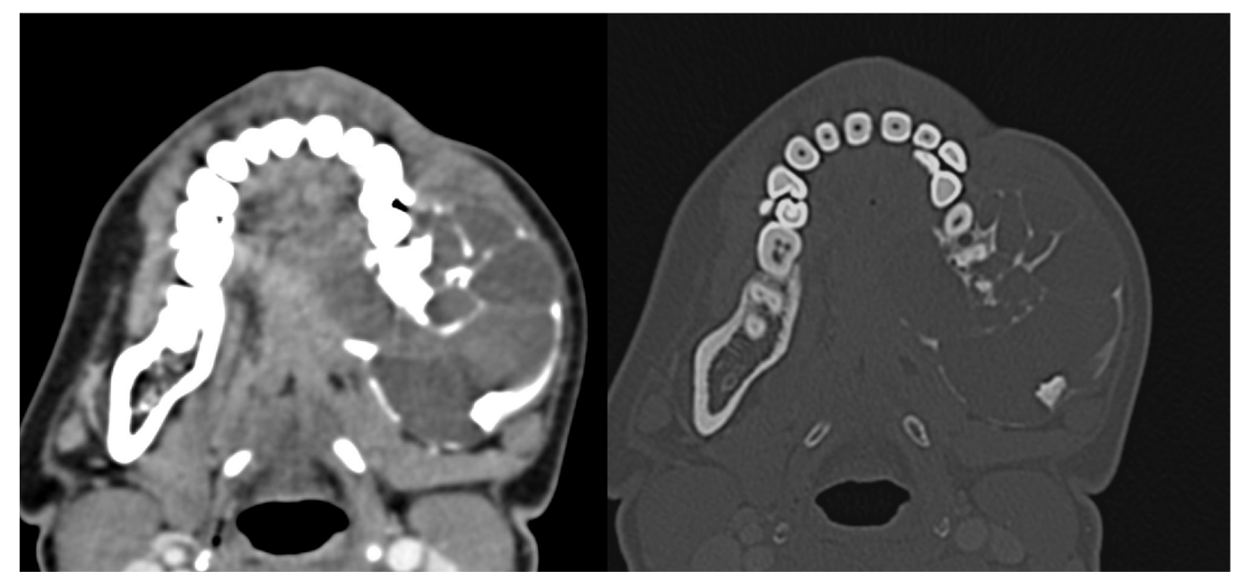 Axial contrast enhanced CT scan images with soft tissue; (a): and bone window; (b): settings of a 19-year-old male with left mandibular swelling for 5 months shows an expansile multiloculated cystic lesion involving posterior body and ramus of left hemimandible with enhancing soft tissue component within; a: Histopathological analysis revealed Ameloblastoma.