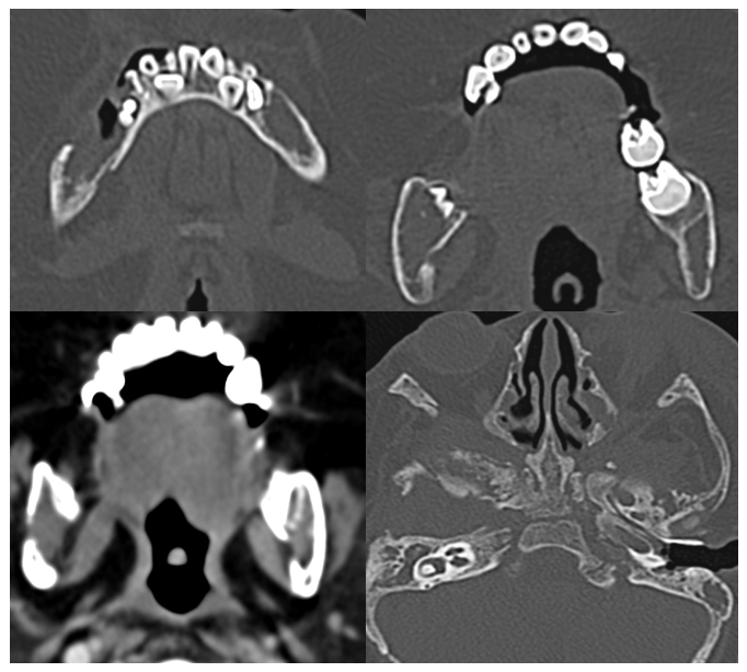 Axial CT scan images with bone window; (a,b,d): and soft tissue; (c): settings of a 3-year-old boy, known case of Langerhans Cell Histiocytosis, with swelling and pain in the jaw since 2 months showing multiple lytic lesions involving the body of bilateral hemi-mandible and skull base.