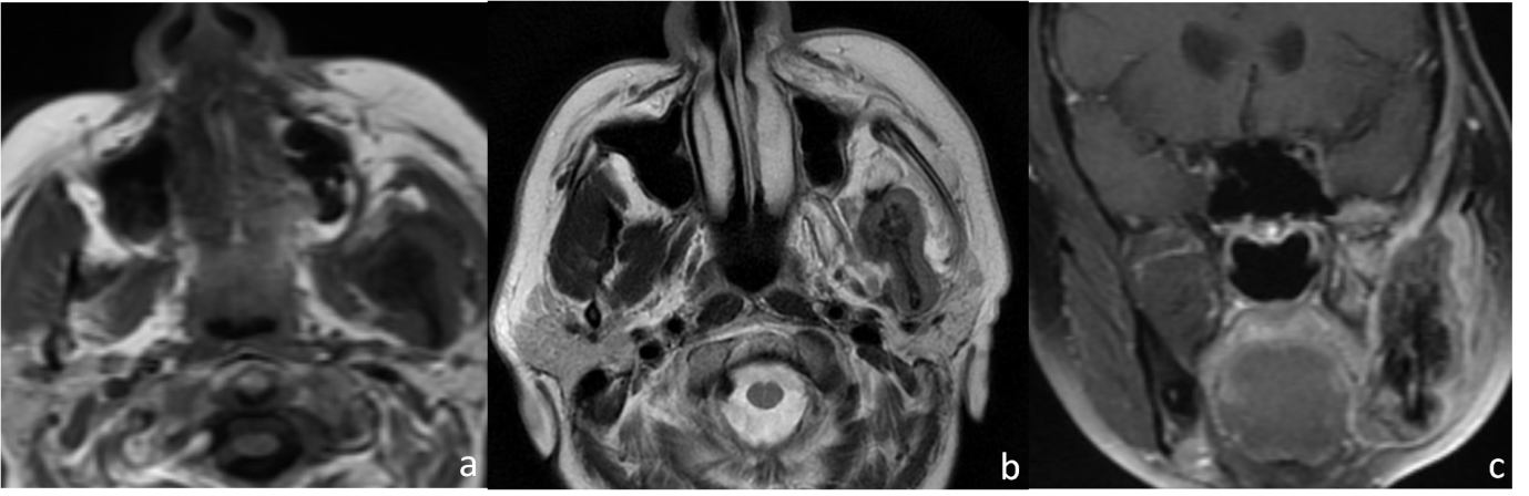 Axial T1; (a): T2; (b): and coronal T1 post-contrast MRI images; (c): of a 58-year-old male with known metastatic lung cancer, presenting with painful mandibular swelling for 2 months, show T1; (a): and T2; (b): intermediate signal soft tissue lesion involving left hemi-mandible with post-contrast enhancement; (c): Histopathological analyses confirmed metastases to the mandible.