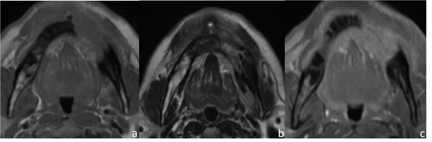 T1(a): T2(b): and post-contrast T1(c): axial MRI images of a 63-year-old male, a known case of multiple myeloma, with left mandibular swelling for 2 months show T1 and T2 intermediate signal lesion in left hemi mandible which shows mild post-contrast enhancement.