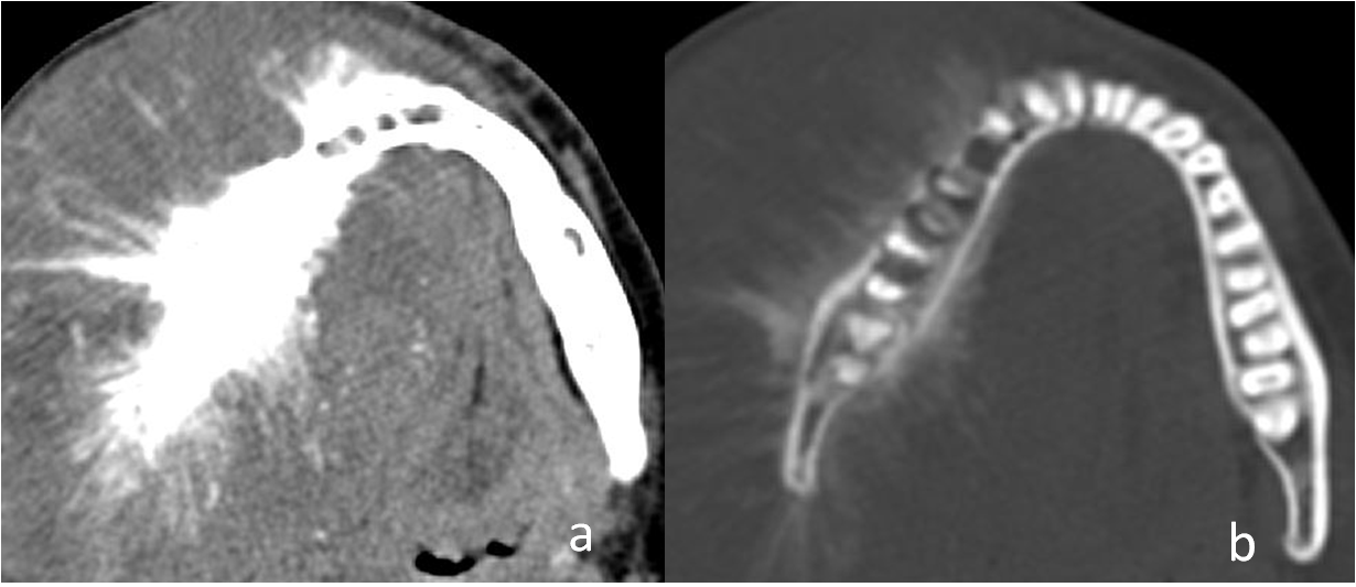 Axial soft tissue (a): and bone window (b): CT images of a 23-year-old woman with complaints of painful right mandibular swelling for 3 months and spontaneous loss of teeth show an expansile lytic lesion involving hemi-mandibular right body, ramus and condyle with sunburst pattern of periosteal reaction. Histopathological analyses revealed osteosarcoma.