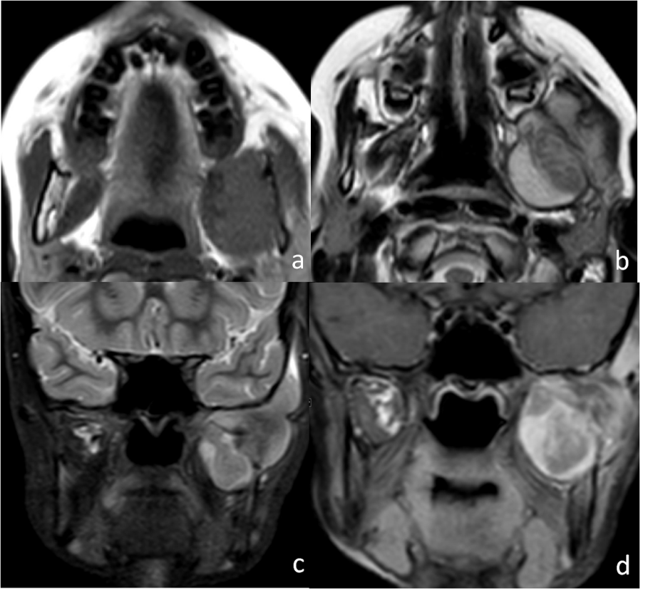 Axial T1 (a): T2 (b): coronal STIR (c): and post-contrast coronal T1 (d): MRI images of an 11-year-old male with a history of gradually increasing painful swelling of the left mandible since 1 month, with difficulty in chewing and mouth opening past 20 days shows T1 hypointense; T2 intermediate; STIR hyperintense; lesion in the ramus of left hemi-mandible with associated soft tissue component in the masticator space. It shows avid heterogeneous enhancement; Histopathological analyses revealed alveolar rhabdomyosarcoma of the mandible.