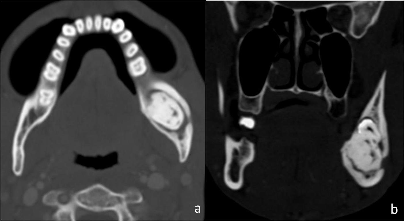 A 33 year old male presented with gradually progressive left mandibular swelling, bone window of axial and coronal CT images; (a,b): show a well-defined, left mandibular expansile lesion with dense sclerotic centre surrounded by radiolucent halo and a contour bulge. Radiological findings favour a complex odontoma.