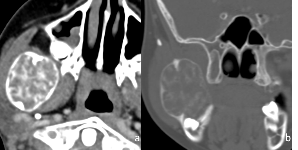 Axial CT scan images with soft window; (a): and bone window; (b): settings of a 12-year-old boy with right jaw swelling and pain since 5 months and difficulty in chewing, shows a well-defined, expansile lesion causing cortical thinningin the right ramus of the mandible. No hypodense halo seen. It closely abuts last molar tooth. Histopathology revealed ossifying fibroma.