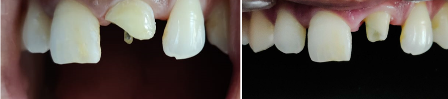 Fiber post & core build up