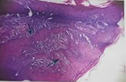 Pseudoepitheliomatous hyperplasia