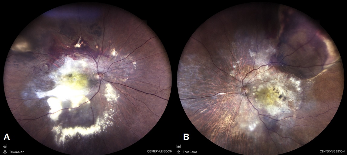 Truecolour image of patient with bilateral PCV showing hemorrhagic PEDs with extensive exudation, sub retinal hemorrhage and scarring in right eye (A) and left eye (B)