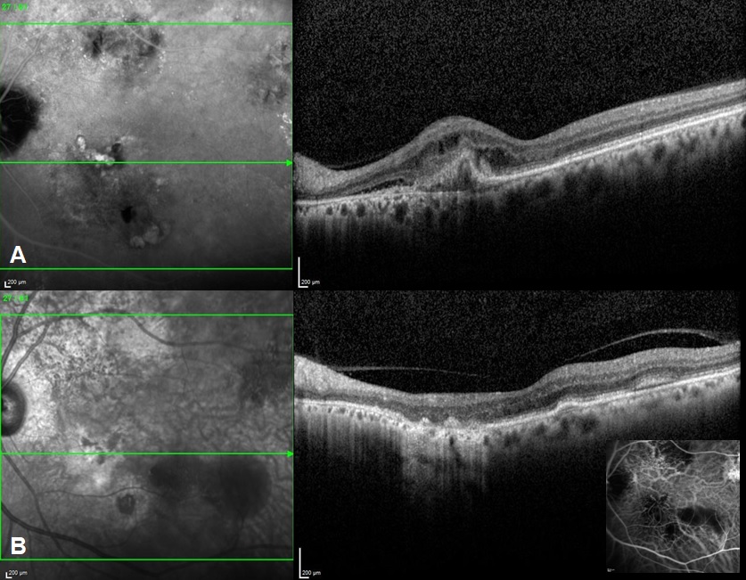 Baseline images showing polyps in ICGA (A) with corresponding SD-OCT images showing PED with inner hyper-reflectivity, minimal SRF and IRF; (B) Follow up OCT images after 5 months of standard fluence PDT showing complete regression of polyps with resolution of SRF and IRF