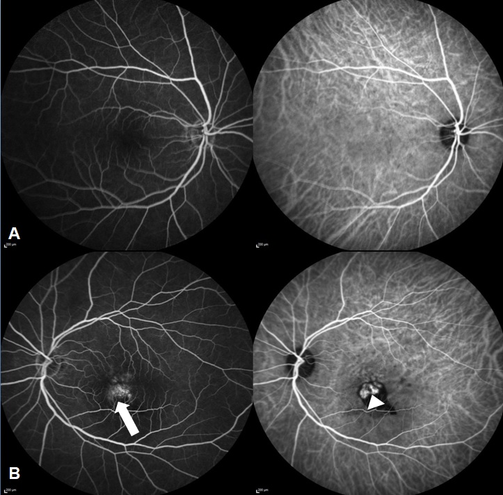 Combined FFA-ICGA of a 59 year old lady showing (A) normal study in right eye and (B) areas of stippled hyper-fluorescence (white arrow) in FFA and corresponding polyps (white arrow head) in early phases of ICGA in left eye