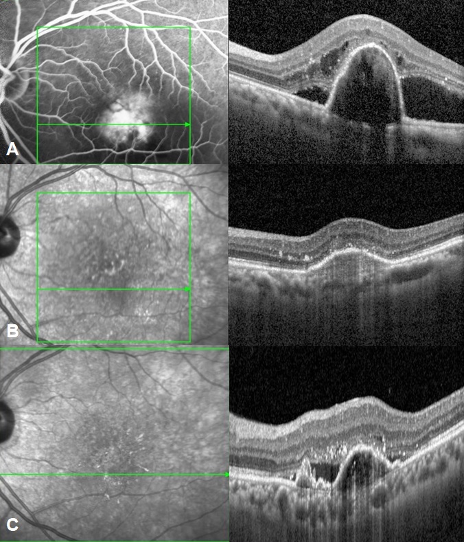 SD-OCT images at baseline (A) showing tall peaked PED with sub retinal fluid and intra retinal fluid. Follow up images (B) at 6 months after reduced-fluence PDT and anti-VEGF therapy showing complete resolution of fluid with multi layering of PED. Follow up images after 2 years (C) showing reactivation of disease at similar site with reappearance of multiple PEDs and SRF