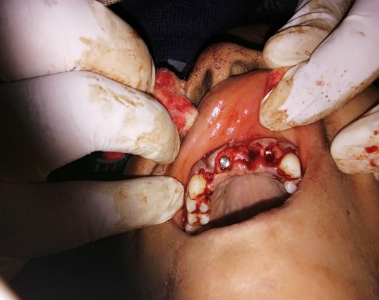 Showing flapless technique was used for accessing the basal bone and Bicortical implant placement. 3.5 mm diameter and 21 mm insertion-length Bicortical screw implant in the edentulous space of maxillary right central and left lateral incisor.