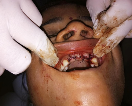 Raised flap was sutured. Thought, flapless technique was used for implant placement. Flaps were raised for the extraction of residual root structure in maxillary right central incisors.