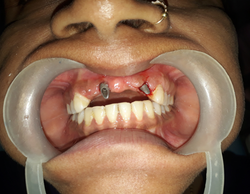 Image showing position of implanted bicortical screw prior to permanent prosthetic. Slightly bleeding is seen as temporary prosthetic was removed. Wound is healed properly.