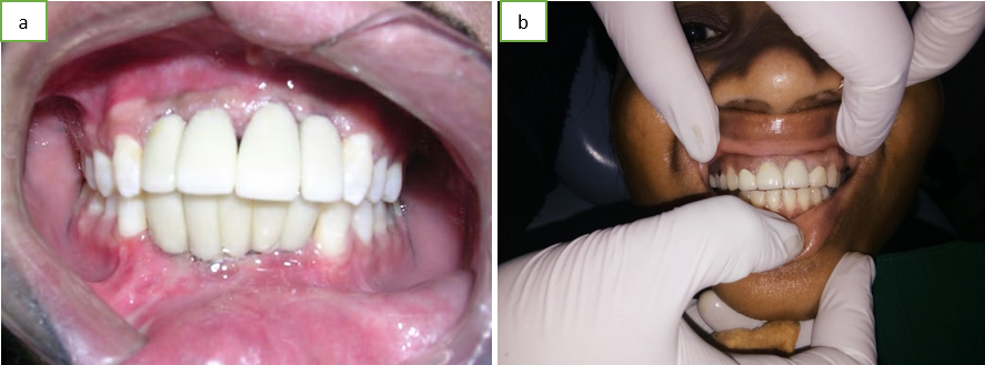 a,b: Permanent prosthetic was loaded in 10th day.
