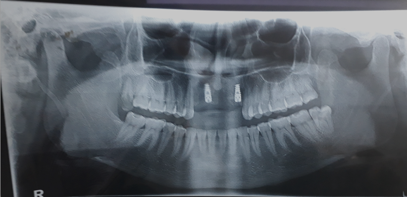 OPG radiographs post implanted taken on day 10.