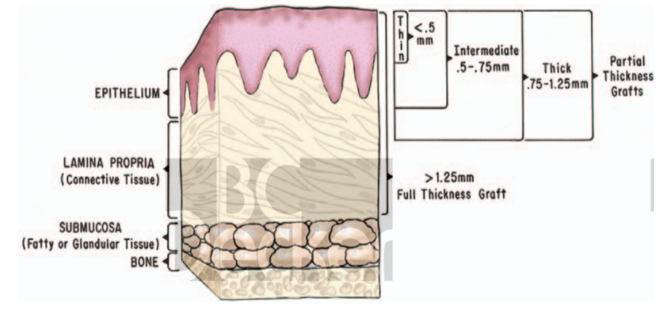 Thickness of graft. Cohen ES. Atlas of cosmetic and reconstructive periodontal surgery. PMPH-USA; 20078.