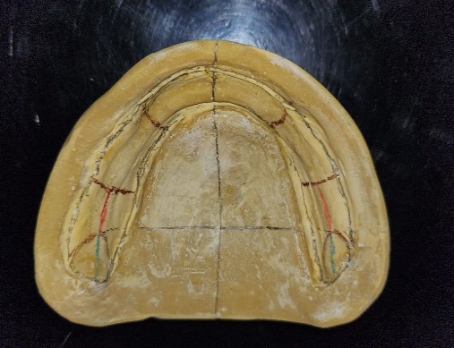 Cast showing markings on retromolar pad and crest of residual ridge