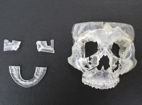 3-D printed surgical guide and splint