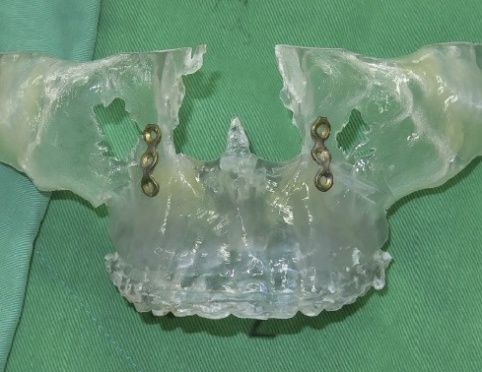 3-D surgical model with precisely adapted miniplate