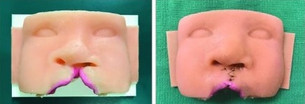 3-D printed surgical simulators for cleft lip repair