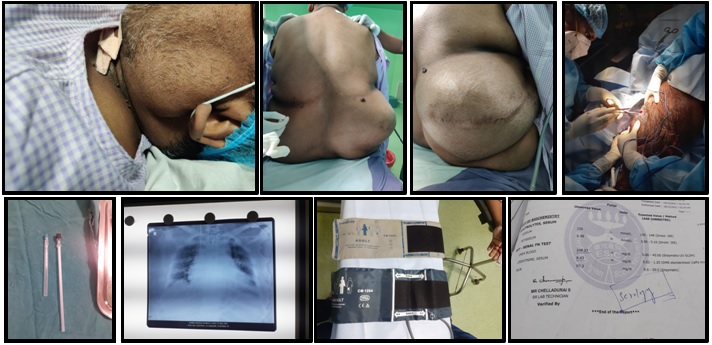 Serial images showing super obesity with curved spine, sacral edema, difficult spinal anaesthesia administration, longer spinal needle, chest x-ray showing cardiomegaly with cardiogenic pulmonary edema, larger Blood pressure cuff and deranged renal function tests