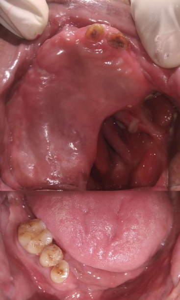 Pre op Intra-Oral view.