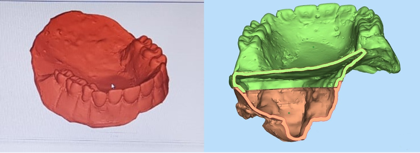 DigitallyCut and hollowed prosthesis device as a STL file.
