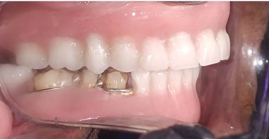 Intra oral view with prosthesis in mouth