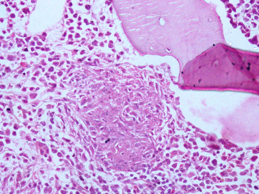 Photo micrograph of bone marrow biopsy showing casseating granuloma in tuberculosis composed of epithelioid cells, lymphocytes. (H&E 200X)