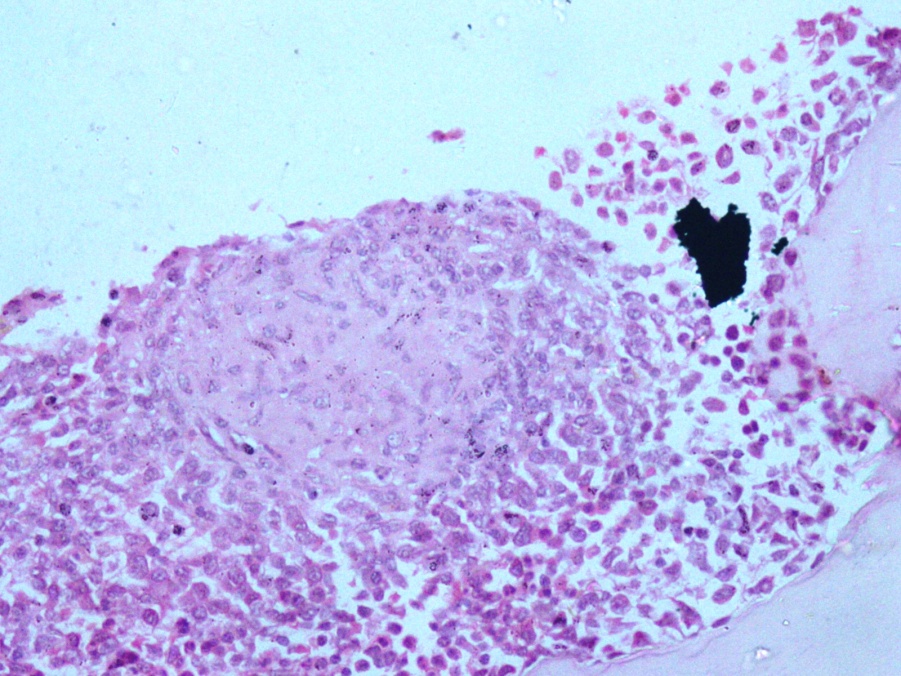 Photo micrograph of bone marrow biopsy showing epithelioid cell granuloma in tuberculosis (H &E 200X)