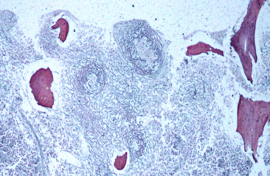Photo micrograph of bone marrow granuloma in tuberculosis showing fibrosis (Reticulin 100X)