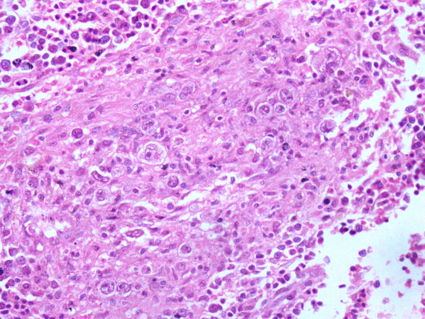 Photo micrograph of bone marrow biopsy inHogdkin’s lymphoma showing epithelioid granuloma (H&E 200X)