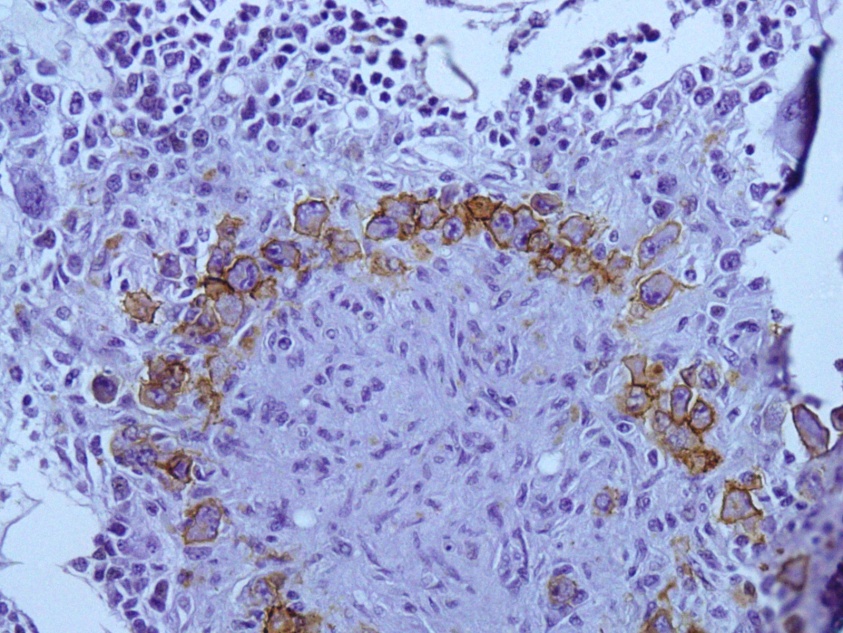 Photo microphagh showing CD 15 positive ReedSternberg cells (IHC -CD-15 400X)