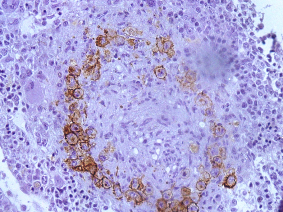 Photo micrograph showing CD-30 positive Reed Sternberg cells (CD-30 IHC 400X)