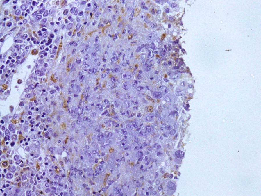 Photo micrograph showing CD68 positiveepithelioid cells and macrophages in Hogdkin’s lymphoma (CD-68 IHC 200X)