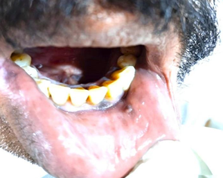 Clinical image showing fibroma in the left corner of the lip