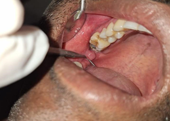 Clinical image showing fibroma in the buccal mucosa in relation to 18